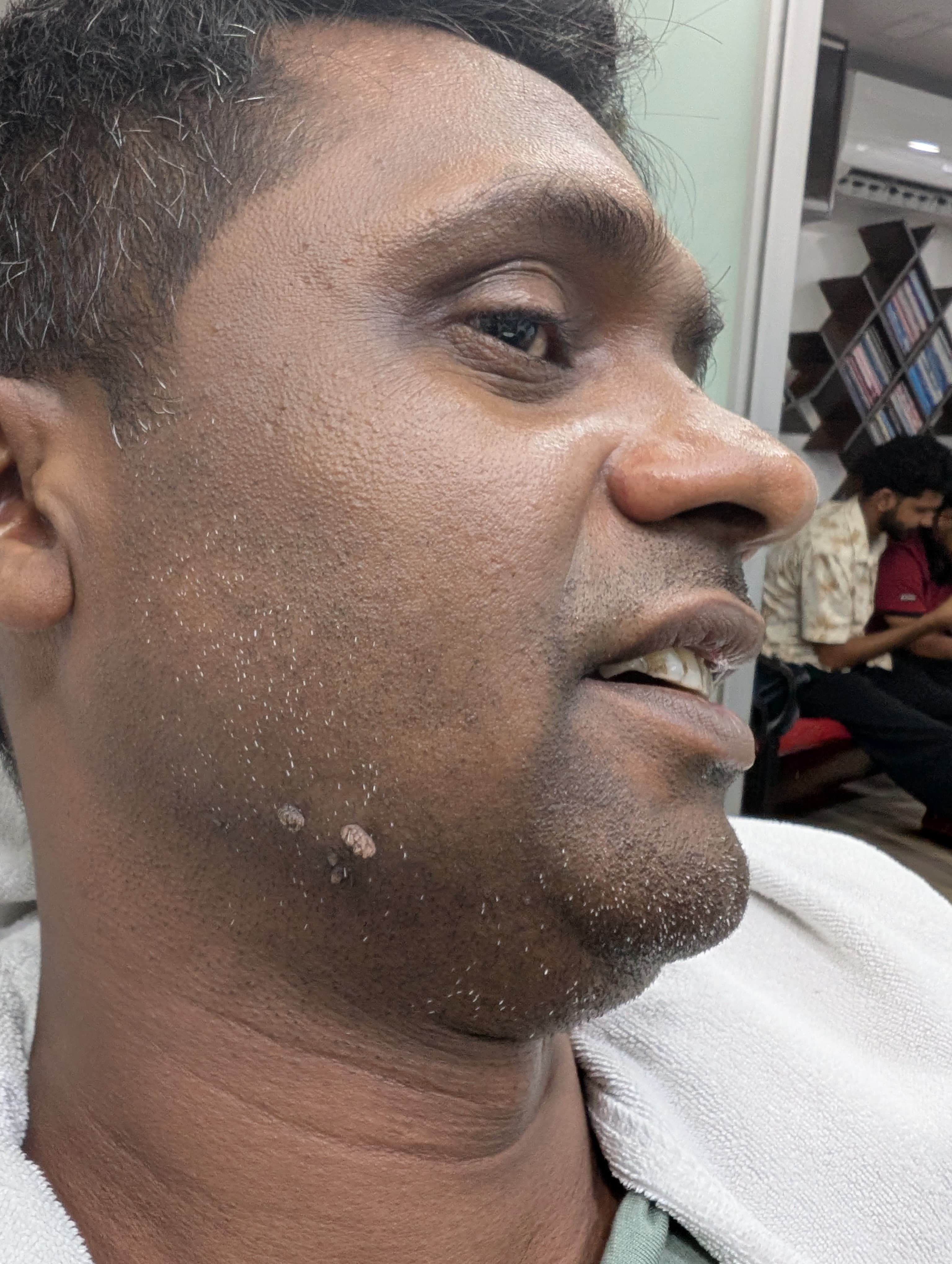 আঁচিল ⁉️ অস্বস্তি নিয়ে সারাক্ষণ থাকা যায়?